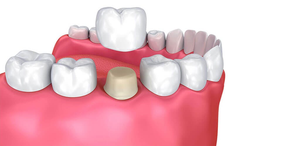 Crowns & Bridges - Dentist Etobicoke - Village Dental