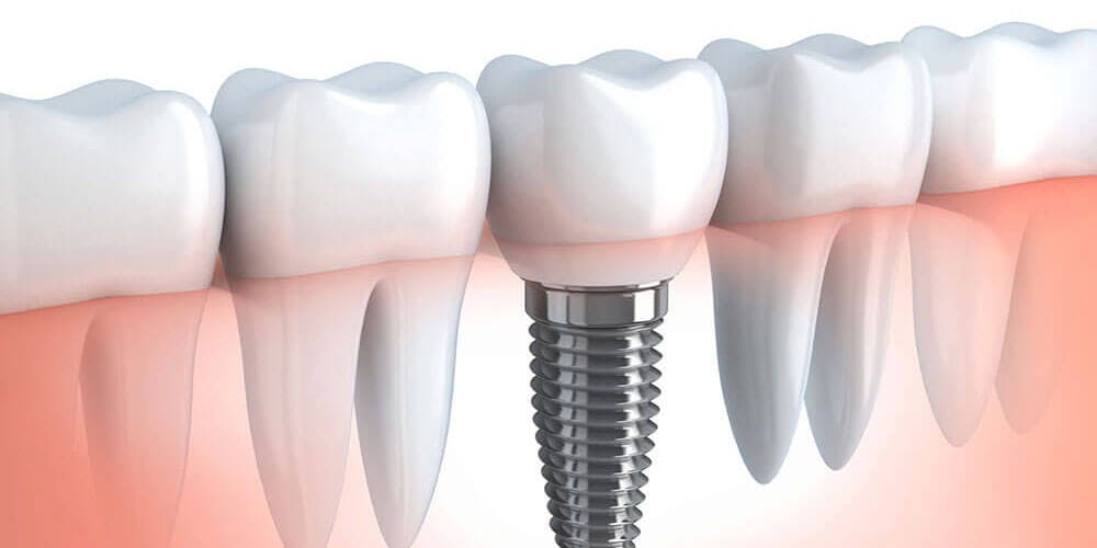 Tooth Implant - Dentist Cornwall - Dentistry @ Cornwall