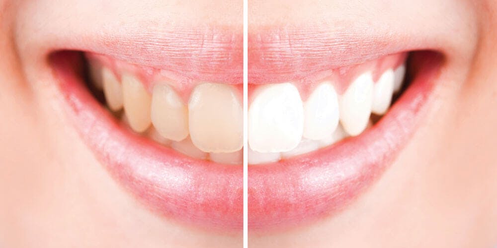 Teeth Whitening - Dentist Cornwall - Dentistry @ Cornwall